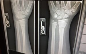 how much is a broken arm worth