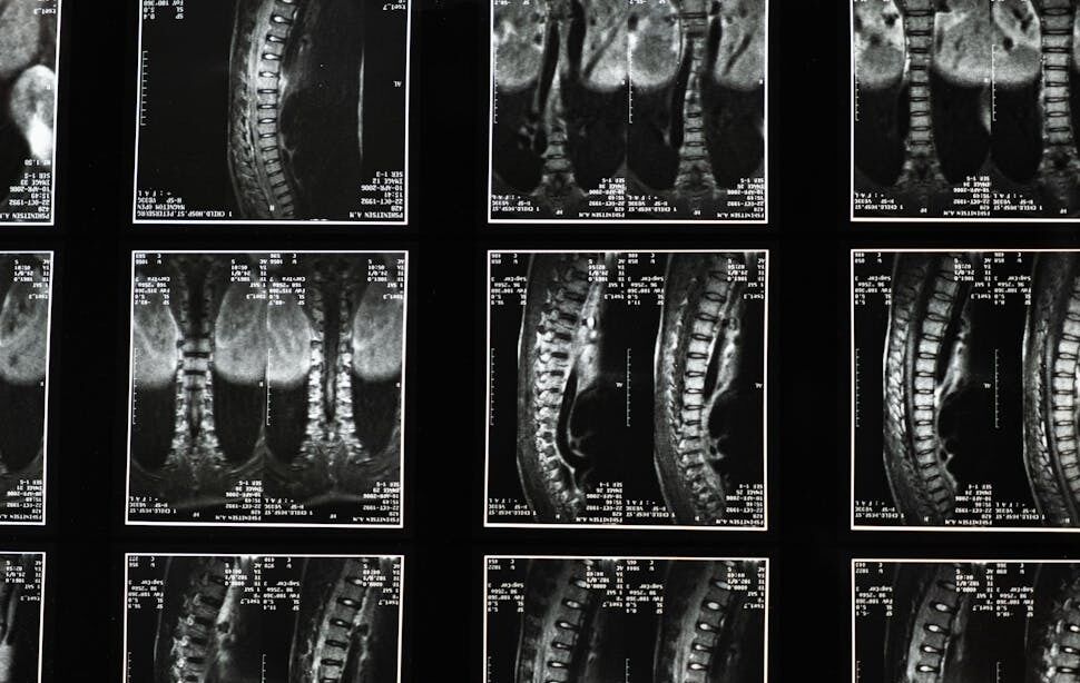 Average Herniated Disc Settlement in Winston-Salemm, NC