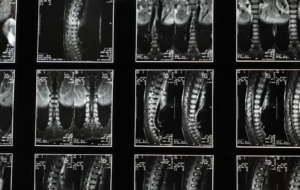 herniated disc settlement in Winston-Salem