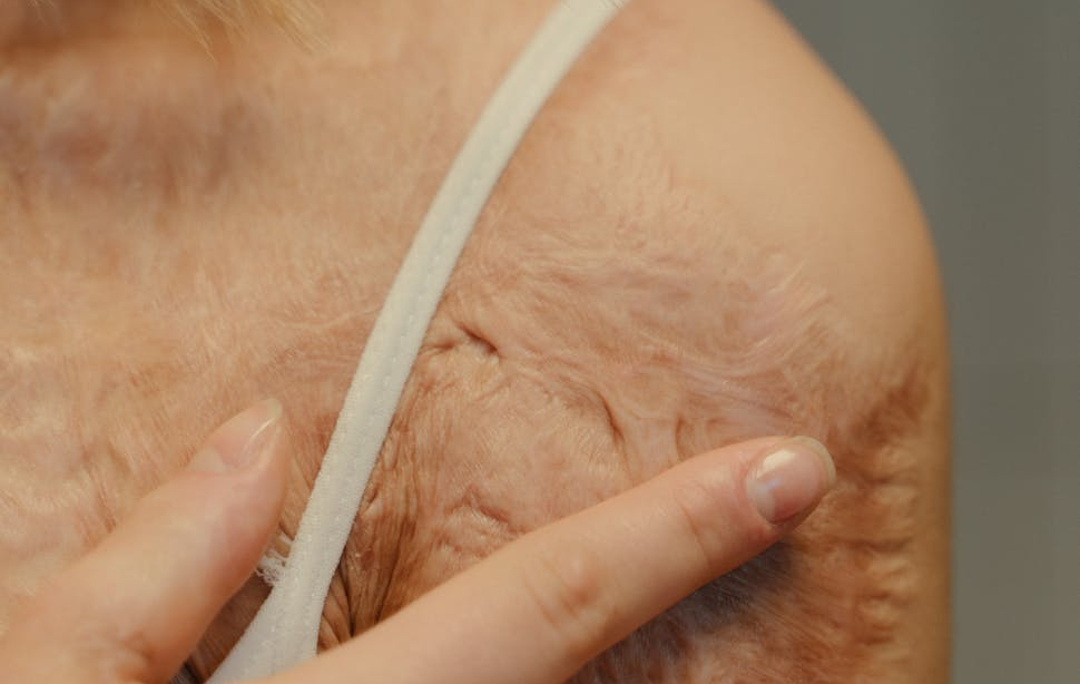 average settlement for burn injury