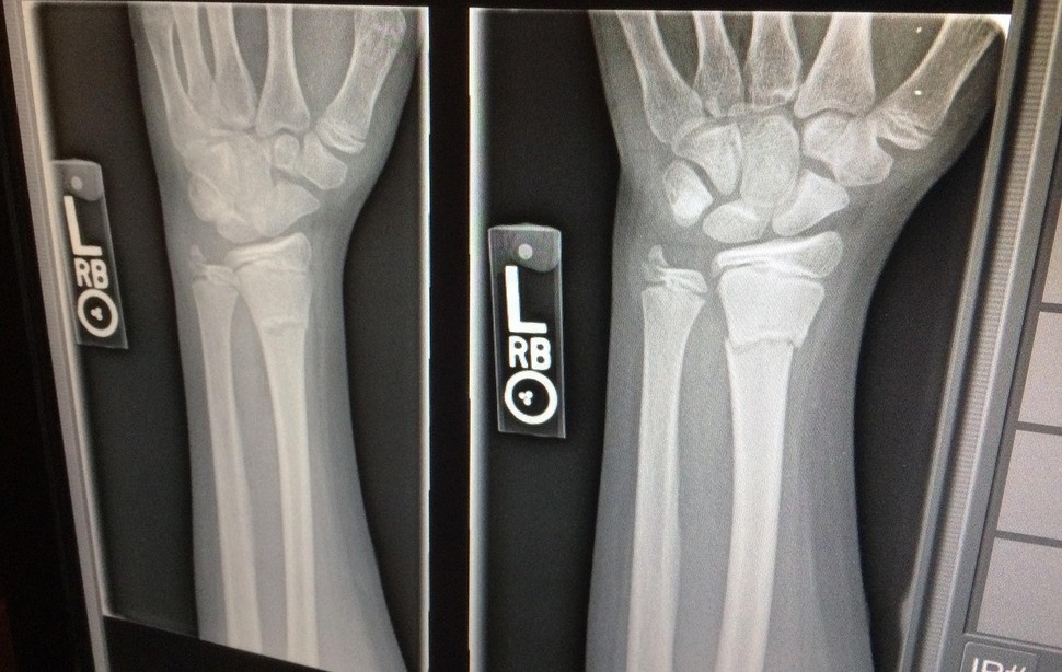 how much is a broken arm worth