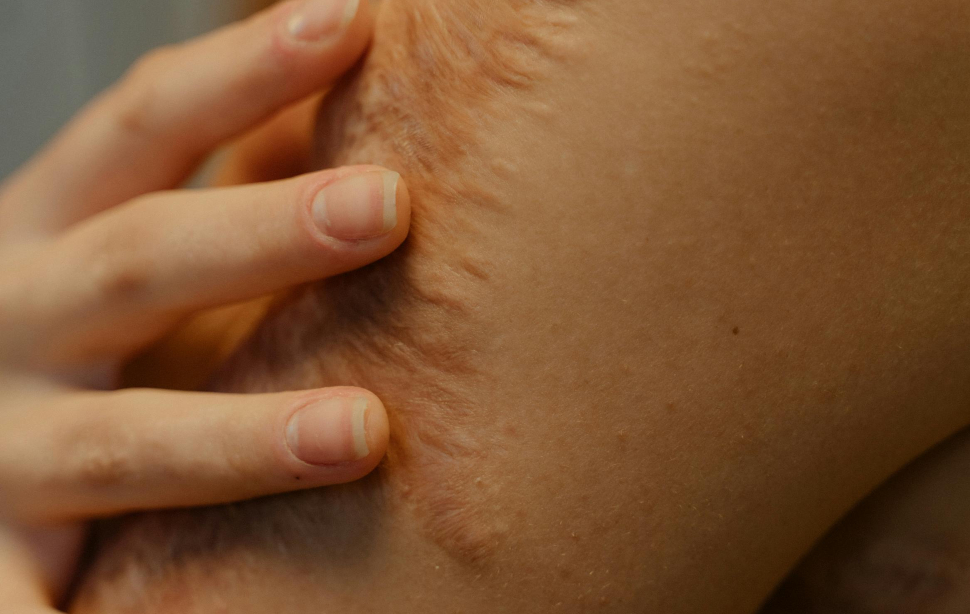 compensation for permanent scarring