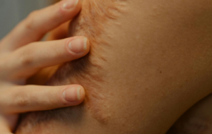compensation for permanent scarring